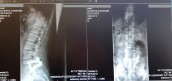 Nowatorskie operacje kręgosłupa w gorzowskim szpitalu