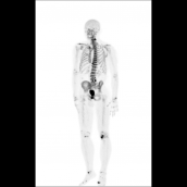 Fluorek sodu pomoże wykryć zmiany nowotworowe w kościach