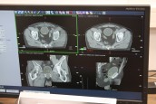 Pół tysiąca pacjentów w Ośrodku Radioterapii